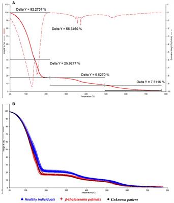 TGA/Chemometric Test Is Able to Detect the Presence of a Rare Hemoglobin Variant Hb Bibba